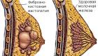 Предменструальный синдром и мастопатия Мастопатия – видео